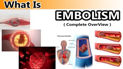 Embolism - What Is It?