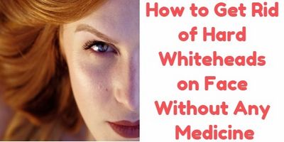Get Rid of Whiteheads on Your Face