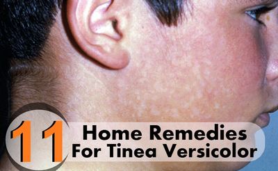 Home Remedies For Tinea Versicolor