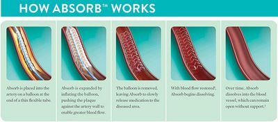 How a Stent Works