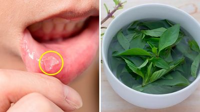 How to Treat a Mouth Ulcer Naturally