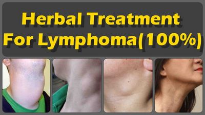 Learn Some Common Lymphoma Symptoms