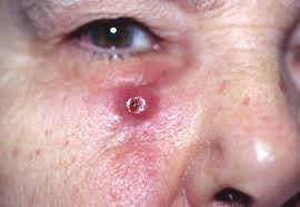 Squamous Cell Carcinomas - What Is The Cause Of This Cancer?