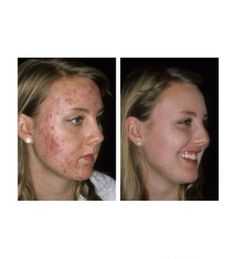 The Facts About Tretinoin and Acne