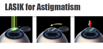 Ways To Treat And Prevent Astigmatism