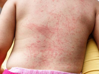 What Are Petechiae?