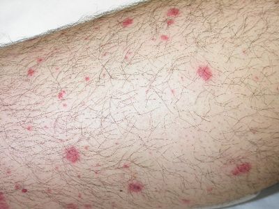 What Are Petechiae?